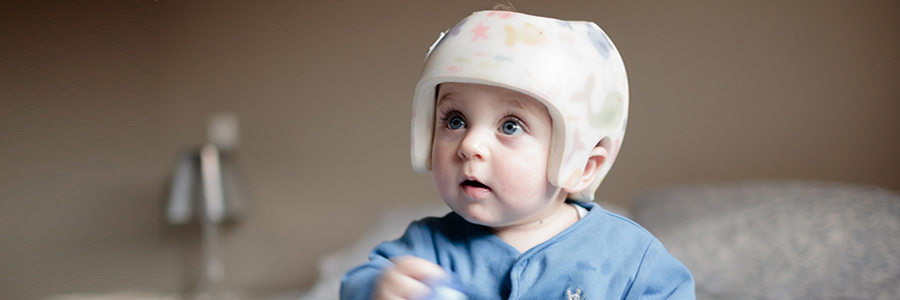 胎儿因头斜畸形而接受头盔治疗