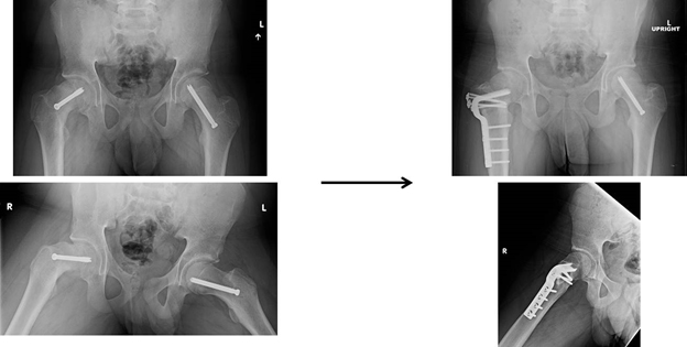x光片显示FAI的治疗方法。