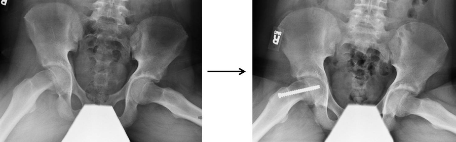x光显示大股骨骺滑移的原位固定。