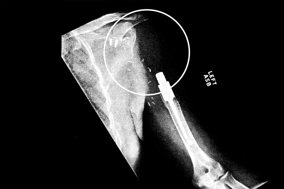 莱纳德·普雷斯顿修复前的肩部x光片