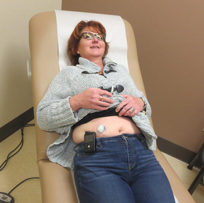 丽莎·康利展示了她腹部的胰岛素泵的位置。