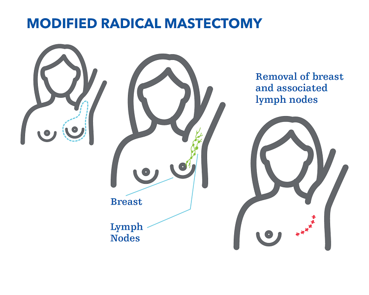 改良根治性乳房切除术