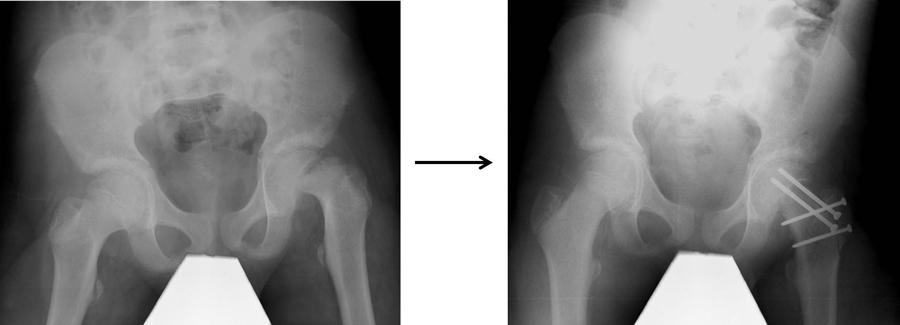 x光显示大股骨骺滑脱的开放性手术。